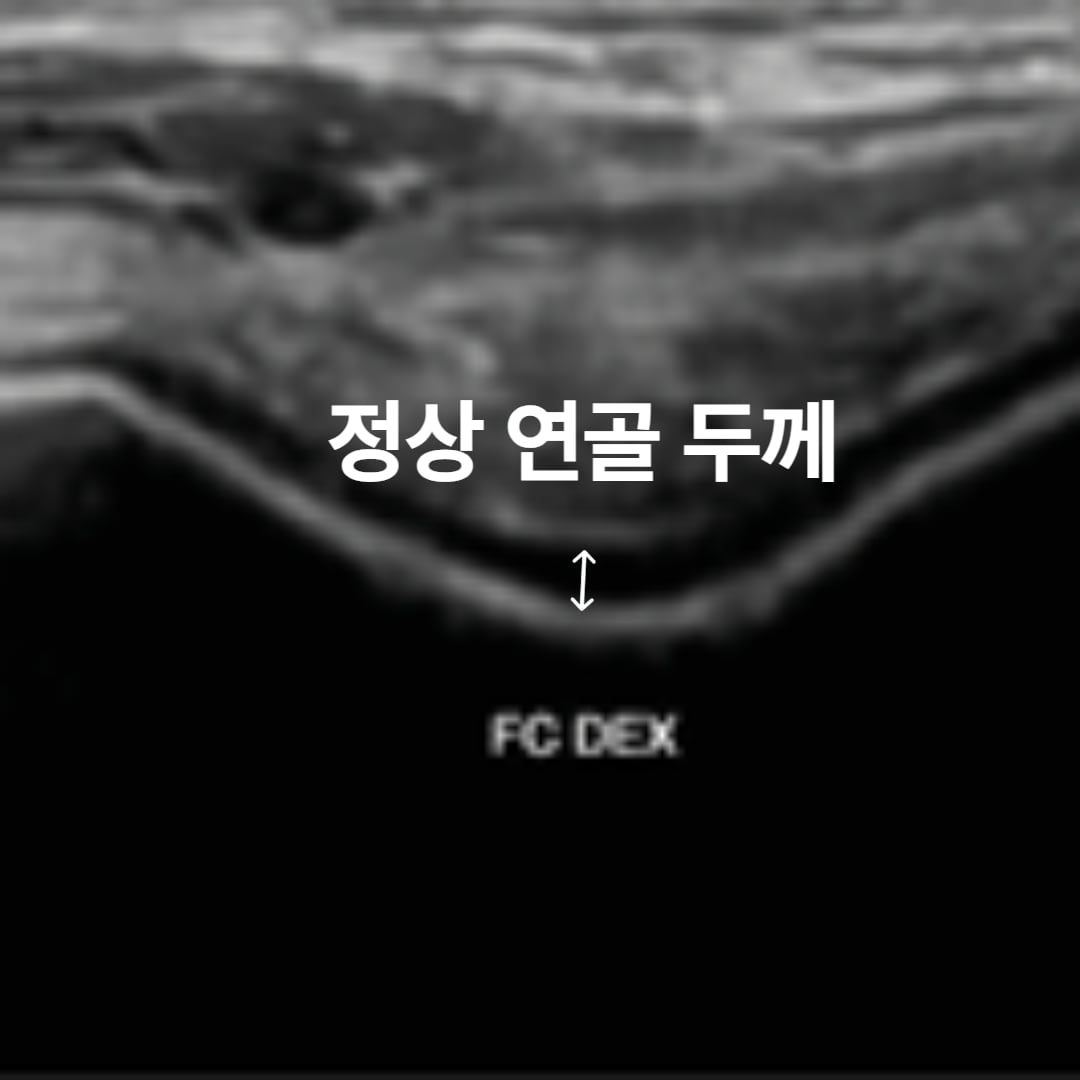 Grade 0 초음파